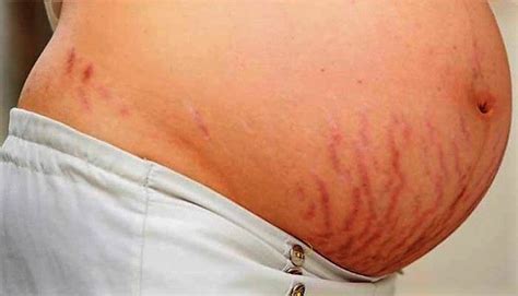 White Stretch Marks The Difference Between Red And White Stretch Marks