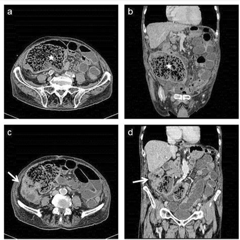 A B Contrast Enhanced Axial And Coronal Ct Scans Show The Presence Of