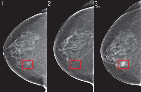 Breast Cancer Digital Mammogram