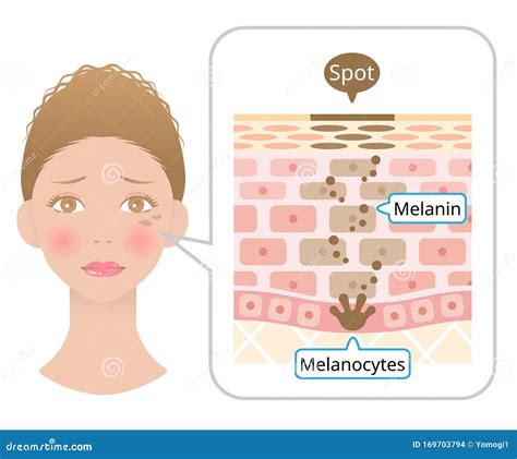 Human Skin Layer With Facial Spot Anatomy Diagram Of Melanin And
