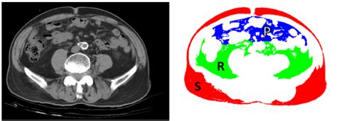 Image Demonstration Of Determining Abdominal Fat Distribution On A Ct