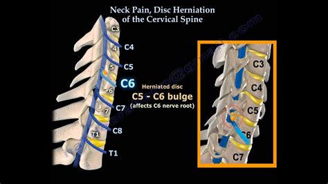 Neck Pain Disc Herniation Of The Cervical Spine Everything You Need