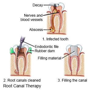 Root canal therapy is an effective dental treatment for deep cavities or tooth trauma that allows you to by the time you need a root canal, it's too late to save the life of the tooth because it's already it may be worse when you eat or bite down. Root Canal - What You Need to Know