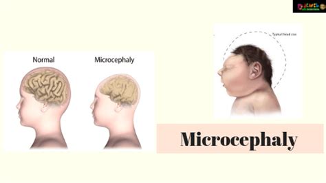 Microcephaly Signs And Symptoms Of Microcephaly