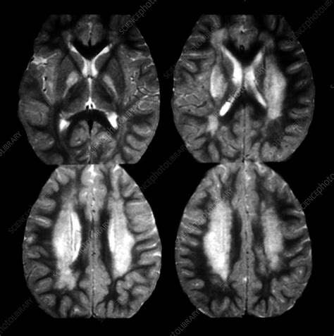 Acute Disseminated Encephalomyelitis Stock Image M1080770