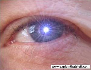How long do the results of lasik last? How does laser eye surgery work? - Explain that Stuff
