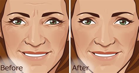 6 Natural Ways To Reduce Deep Wrinkles On Face Including Those