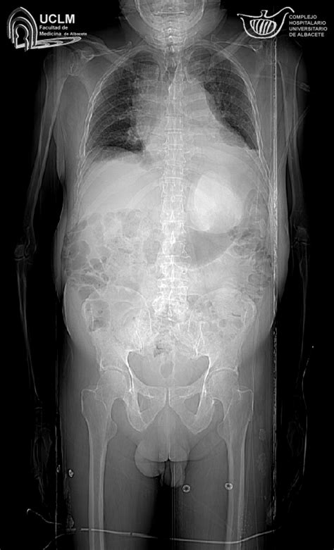 Paciente Que Nota Rápido Crecimiento De Ganglios De Cuello Y Cuerpo