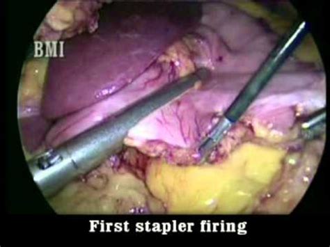 Revisional Bariatric Surgery Band To Sleeve YouTube