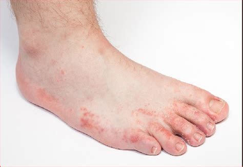 Fungus Foot Symptoms Prevention And Those At Risk Greener Health