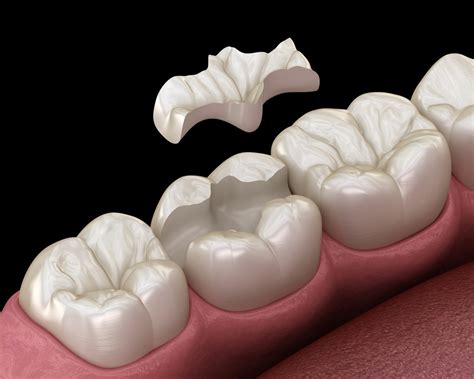 Restorative Dentistry Mocksville Dental Inlays And Onlays