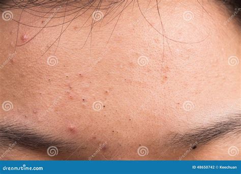 Pimple Blackheads On The Forehead Stock Photo Image 48650742
