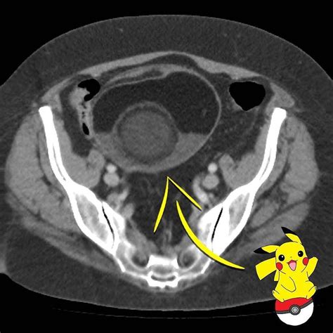Radiology Signs Ovarian Mature Cystic Teratoma Dermoid Cyst On