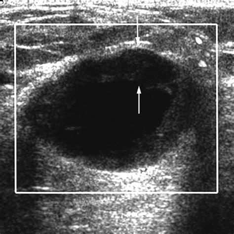 Complex Cystic Breast Masses Diagnostic Approach And Imaging
