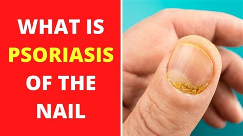 ¿how To Cure Psoriasis Of The Nail What Is Psoriasis Of The Nail