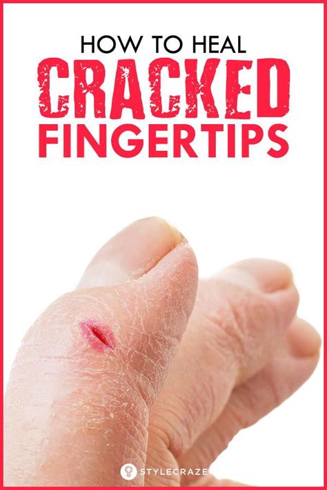 Natural Home Remedies For Cracked Fingertips Cracked Fingertips Dry