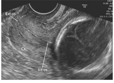 Transvaginal Sonogram Of Normal Cervix In Second Trimester Cx Cervix Download Scientific