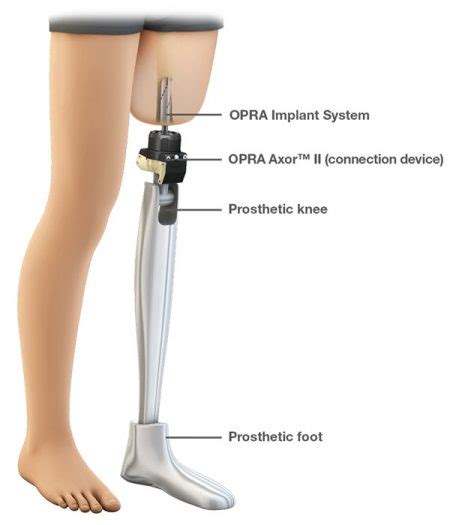 What You Need To Know About Osseointegration Niagara Prosthetics