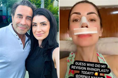 Botcheds Dr Paul Nassif Gives His Own Wife Brittany A Nose Job And She Shares Gruesome Post