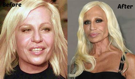 Top 12 Celebrity Plastic Surgery Operations Gone Horribly Wrong Before And After Photos