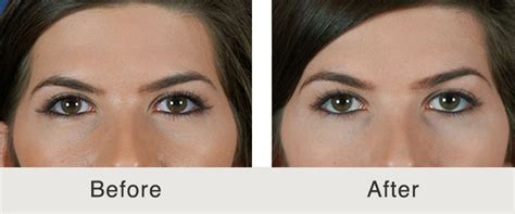 Botox® was also used to diminish marionette lines, chin dimples, and to improve neck. Botox Brow Lift Guide: Results - Costs - Side Effects & Risks