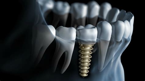 Osseointegration And The Duration Of A Dental Implant