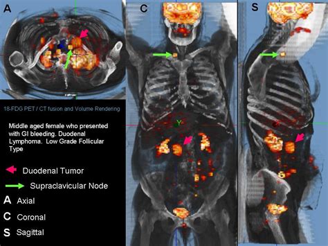 Somatype Follicular Lymphoma Of The Duodenum Volume Rendered Pet Ct