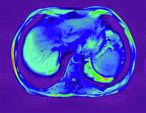 Cross Section Abdomen Mri Scan Of 60 Year Old Male Patient With Kidney