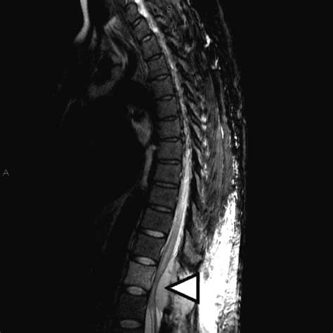 On Radiology Diagnosing Of Spinal Cord Compression