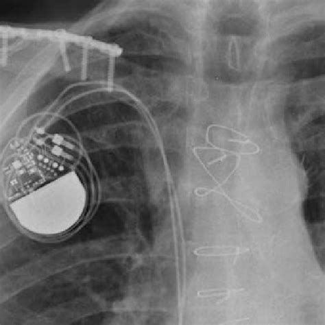 Postoperative X Ray Control After Pacemaker Implantation Download