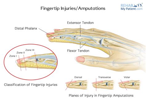 Fingertip Injuriesamputations Rehab My Patient