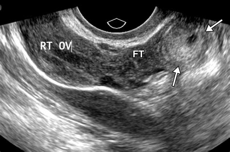 Imaging Evaluation Of Fallopian Tubes And Related Disease A Primer For