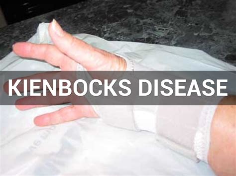 Kienbocks Disease By Laura Cashman