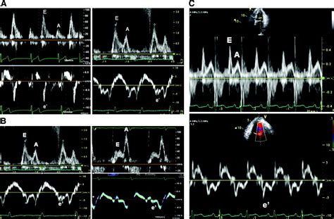 Established And Novel Clinical Applications Of Diastolic Function