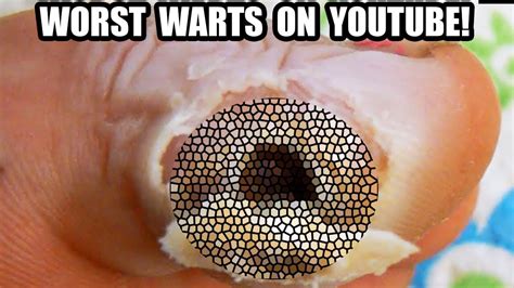Wart Removal Youtubes Worst Warts Youtube