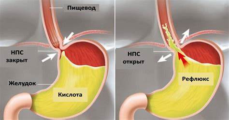 Подагра диета клинические рекомендации Подагра диета клинические рекомендации