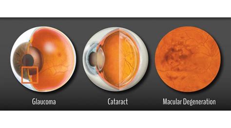 Introduction To Eyesight And Eye Health Eyelinkscentral