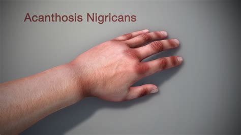 Acanthosis Nigricans Shown And Described Using A 3d Medical Animation