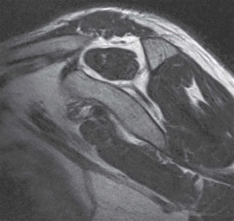 Anteroposterior Plain Radiograph Of The Left Shoulder With The Crescent