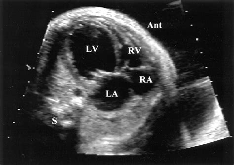 Premature Closure Of The Foramen Ovale And Ductus Arteriosus In A Fetus