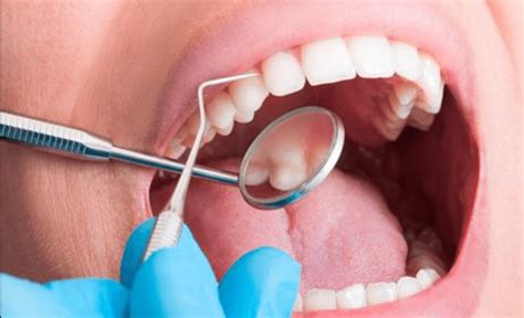 Higiene Dental Clinica Dental Blanc