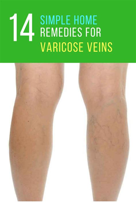 Home Remedies For Varicose Veins Slide Share