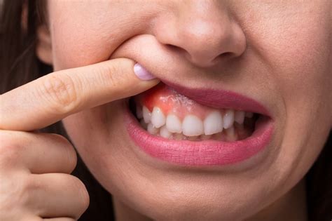 Swollen Gums In Ocala Weldon General And Cosmetic Dentistry