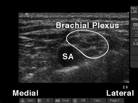 Figure 1 From Ultrasound Guided Supraclavicular Brachial Plexus Nerve