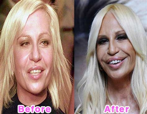 Celebrity Plastic Surgery Disasters Before And After Pics