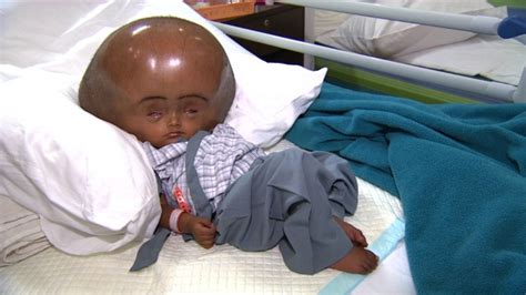 Indian Child Roona Begum Recovering After Hydrocephalus Surgery