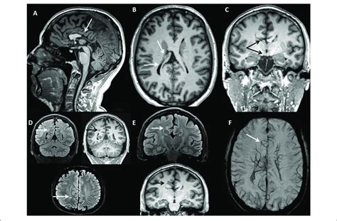 Brain Mri Case 1 A Sagittal 3d Magnetization Prepared Rapid