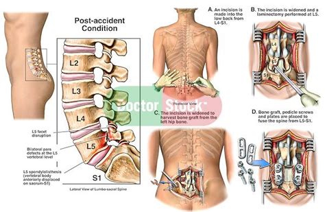 Low Back Injury L5 Lumbar Spine Fracture And Spondylolisthesis With