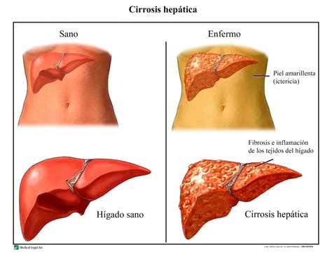 Cirrosis hepática clasificación y causas