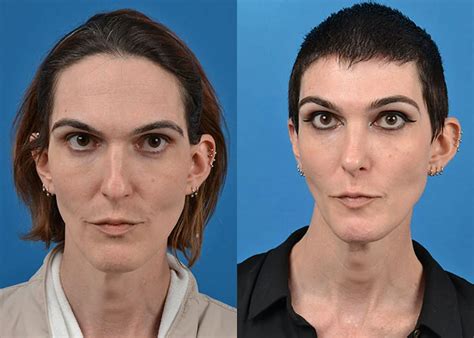 Facial Feminization Surgery In Central Florida